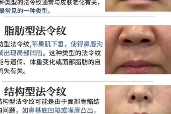 法令纹的形成原因与改善方法解析