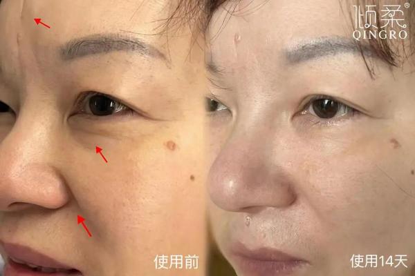 面部抗衰老：鱼尾纹的修复技巧
