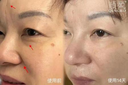 面部抗衰老：鱼尾纹的修复技巧