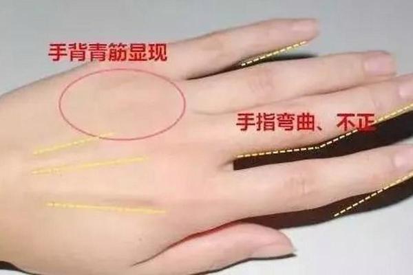 揭秘神奇手相：手指长有肉竟是财运亨通的预兆