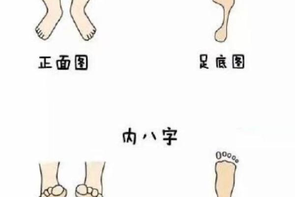 八字脚让你走路不稳？看这里，教你如何恢复正常步态