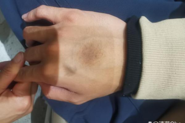 神秘手背痣：揭秘你的运势与人生轨迹