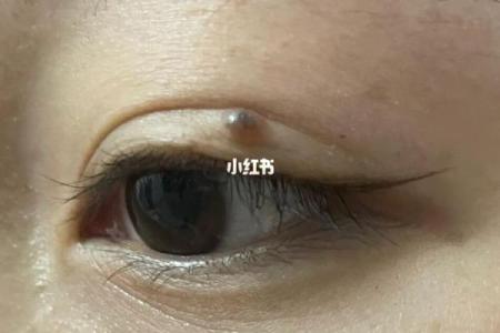 眼皮痣的传说：揭秘女性运势的神秘符号