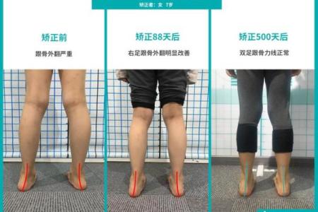 轻松矫正八字脚，改变你的步态，提升自信