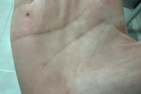 一颗小贵痣，改变你的人生轨迹
