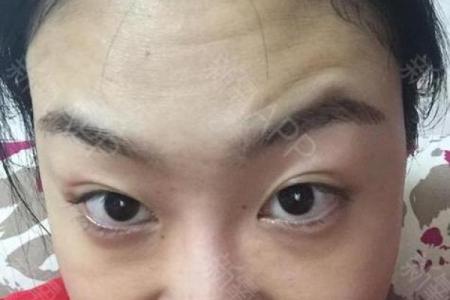 八字纹额头如何改善？改变命运的三大方法